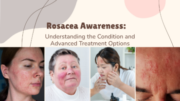 Rosacea Awareness: Understanding the Condition and Advanced Treatment Options