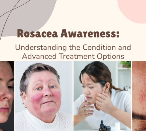 Rosacea Awareness: Understanding the Condition and Advanced Treatment Options